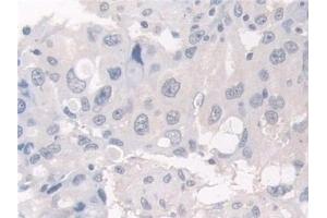 Detection of HPS4 in Human Breast cancer Tissue using Polyclonal Antibody to Hermansky Pudlak Syndrome Protein 4 (HPS4)