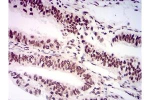 Immunohistochemical analysis of paraffin-embedded endometrial cancer tissues using AKT1S1 mouse mAb with DAB staining.