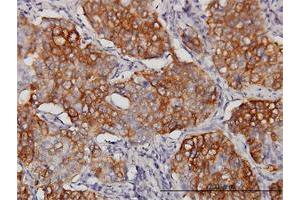 Immunoperoxidase of monoclonal antibody to EIF4G3 on formalin-fixed paraffin-embedded human lung, adenosquamous cell carcinoma. (EIF4G3 anticorps  (AA 1-515))