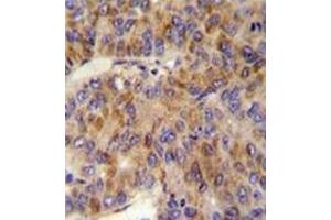 Immunohistochemistry analysis in formalin fixed and paraffin embedded human hepatocarcinoma reacted with bMINPP1 Antibody (N-term) followed by peroxidase conjugation of the secondary antibody and DAB staining.