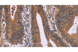 Immunohistochemistry of paraffin-embedded Human colon cancer using CMTM6 Polyclonal Antibody at dilution of 1:30 (CMTM6 anticorps)