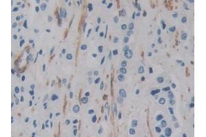 Detection of ACTg2 in Human Prostate cancer Tissue using Polyclonal Antibody to Actin Gamma 2, Smooth Muscle (ACTg2)