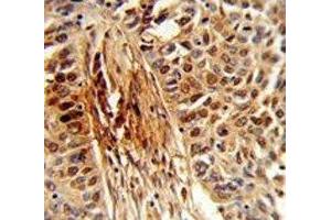IHC analysis of FFPE human lung carcinoma stained with PIN1 antibody