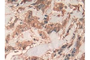 Detection of PHB in Human Breast cancer Tissue using Polyclonal Antibody to Prohibitin (PHB)