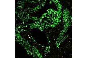 IF analysis of CTBP2 using anti-CTBP2 antibody (ABIN3042768) P-cadherin was detected in paraffin-embedded section of human colon cancer tissues. (CTBP2 anticorps  (AA 321-445))