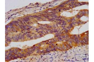 IHC image of ABIN7178015 diluted at 1:500 and staining in paraffin-embedded human colon cancer performed on a Leica BondTM system. (WDR37 anticorps  (AA 1-496))