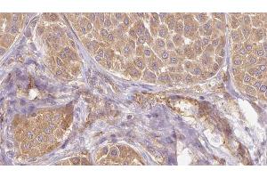 ABIN6273831 at 1/100 staining Human Melanoma tissue by IHC-P. (PAEP anticorps)
