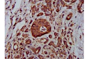 IHC image of ABIN7159086 diluted at 1:400 and staining in paraffin-embedded human pancreatic cancer performed on a Leica BondTM system.