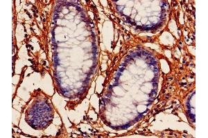 Immunohistochemistry of paraffin-embedded human colon cancer using ABIN7164219 at dilution of 1:100