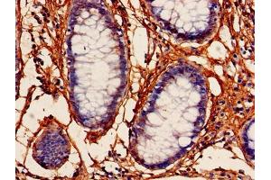 Immunohistochemistry of paraffin-embedded human colon cancer using ABIN7164219 at dilution of 1:100 (PFDN5 anticorps  (AA 2-154))