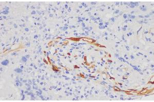 Immunohistochemistry of paraffin-embedded Human lung cancer using S100A7 Polycloanl Antibody at dilution of 1:200 (S100A7 anticorps)