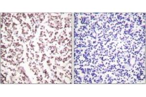 Immunohistochemistry analysis of paraffin-embedded human lymph node tissue, using Bloom Syndrome (Ab-99) Antibody. (Bloom Syndrome (AA 65-114) anticorps)
