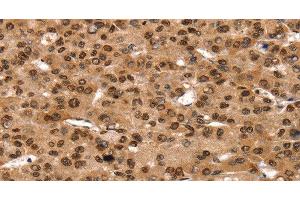 Immunohistochemistry of paraffin-embedded Human liver cancer using TAF10 Polyclonal Antibody at dilution of 1:35