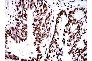 Immunohistochemical analysis of paraffin-embedded rectum cancer tissues using ZFP91 mouse mAb with DAB staining.