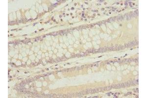 Immunohistochemistry of paraffin-embedded human colon cancer using ABIN7171839 at dilution of 1:100 (ASPSCR1 anticorps  (AA 284-553))