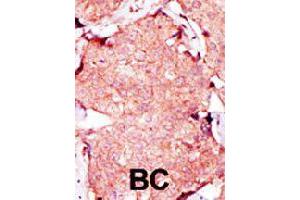 Formalin-fixed and paraffin-embedded human breast cancer tissue reacted with AK3L1 polyclonal antibody  , which was peroxidase-conjugated to the secondary antibody, followed by AEC staining. (AK4 anticorps  (C-Term))