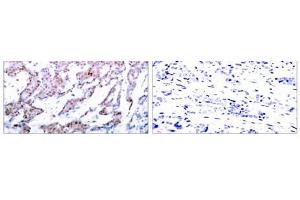 Immunohistochemical analysis of paraffin-embedded human breast carcinoma tissue using NF-κB p65 (phospho-Ser536) antibody (E011014). (NF-kB p65 anticorps  (pSer536))