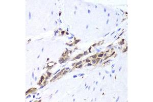 Immunohistochemistry of paraffin-embedded human gastric cancer using TPPP3 antibody.