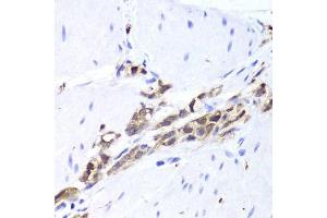 Immunohistochemistry of paraffin-embedded human gastric cancer using TPPP3 antibody. (TPPP3 anticorps  (AA 1-176))