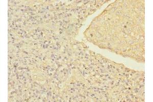 Immunohistochemistry of paraffin-embedded human lung cancer using ABIN7168214 at dilution of 1:100 (MRRF anticorps  (AA 56-262))