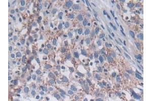Detection of SNX13 in Human Lung cancer Tissue using Polyclonal Antibody to Sorting Nexin 13 (SNX13)