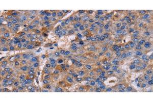Immunohistochemistry of paraffin-embedded Human liver cancer using NPM3 Polyclonal Antibody at dilution of 1:60 (NPM3 anticorps)