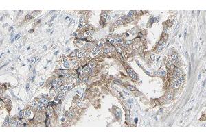 ABIN6278574 at 1/100 staining Human prostate tissue by IHC-P. (GIT1 anticorps  (Internal Region))