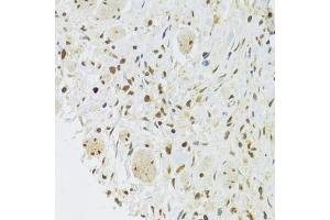 Immunohistochemistry of paraffin-embedded human gastric cancer using EFTUD2 Antibody (ABIN5974236) at dilution of 1/100 (40x lens). (EFTUD2 anticorps)