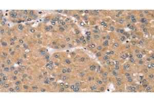 Immunohistochemistry of paraffin-embedded Human liver cancer tissue using RBM38 Polyclonal Antibody at dilution 1:45 (RBM38 anticorps)