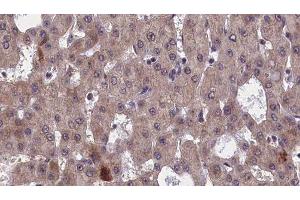 ABIN6277552 at 1/100 staining Human liver cancer tissue by IHC-P. (GFRA1 anticorps  (Internal Region))