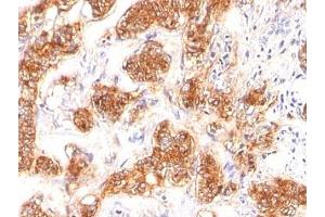 Formalin-fixed, paraffin-embedded human breast carcinoma stained with MFG-E8 antibody (SPM291)