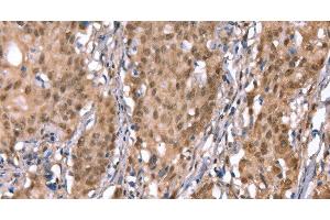 Immunohistochemistry of paraffin-embedded Human gasrtic cancer tissue using KCNJ6 Polyclonal Antibody at dilution 1:40 (KCNJ6 anticorps)
