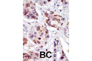 Formalin-fixed and paraffin-embedded human cancer tissue reacted with PIP4K2C polyclonal antibody  , which was peroxidase-conjugated to the secondary antibody, followed by AEC staining. (PIP4K2C anticorps  (C-Term))