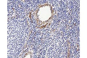 Immunohistochemistry analysis of paraffin-embedded human Lymphoma using LDLR Polyclonal Antibody at dilution of 1:300. (LDLR anticorps)