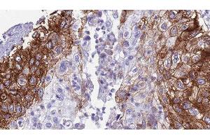 ABIN6276730 at 1/100 staining Human urothelial cancer tissue by IHC-P. (IL-6 Receptor anticorps  (N-Term))