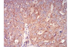 Immunohistochemical analysis of paraffin-embedded ovarian cancer tissues using Rab6b mouse mAb with DAB staining.