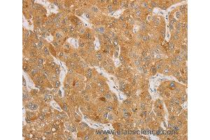 Immunohistochemistry of Human thyroid cancer using NGF Polyclonal Antibody at dilution of 1:50 (Nerve Growth Factor anticorps)