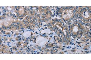 Immunohistochemistry of paraffin-embedded Human thyroid cancer using HOMER1 Polyclonal Antibody at dilution of 1:50 (HOMER1 anticorps)