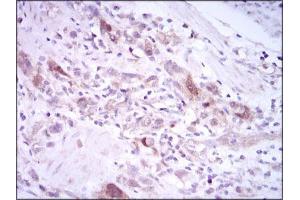 Immunohistochemical analysis of paraffin-embedded stomach cancer tissues using PLK1 mouse mAb with DAB staining.