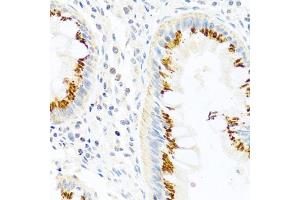 Immunohistochemistry of paraffin-embedded human colon using FB antibody (ABIN3021390, ABIN3021391, ABIN3021392 and ABIN6215001) at dilution of 1:100 (40x lens).