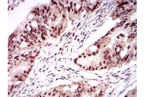 Immunohistochemical analysis of paraffin-embedded rectum cancer tissues using ONECUT3 mouse mAb with DAB staining.