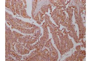 IHC image of ABIN7143869 diluted at 1:500 and staining in paraffin-embedded human colon cancer tissue performed on a Leica BondTM system.