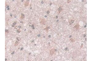 Detection of CXADR in Human Glioma Tissue using Polyclonal Antibody to Coxsackie Virus And Adenovirus Receptor (CXADR)