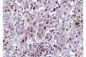 ABIN6272864 at 1/100 staining human lung carcinoma tissue sections by IHC-P. (METTL3 anticorps)