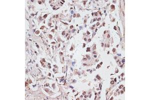 Immunohistochemistry of paraffin-embedded human lung cancer using DKC1 antibody (ABIN6127762, ABIN6139635, ABIN6139636 and ABIN6216722) at dilution of 1:100 (40x lens). (DKC1 anticorps  (AA 1-180))