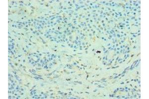 Immunohistochemistry of paraffin-embedded human breast cancer using ABIN7159067 at dilution of 1:100