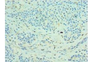 Immunohistochemistry of paraffin-embedded human breast cancer using ABIN7159067 at dilution of 1:100 (MMP14 anticorps  (AA 260-540))