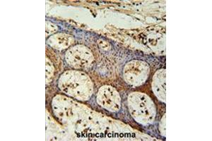 ZC3H3 Antibody (C-term) immunohistochemistry analysis in formalin fixed and paraffin embedded human skin carcinoma followed by peroxidase conjugation of the secondary antibody and DAB staining. (ZC3H3 anticorps  (C-Term))