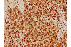 IHC image of ABIN7170790 diluted at 1:500 and staining in paraffin-embedded human ovarian cancer performed on a Leica BondTM system.