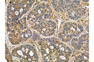 ABIN7095555 and ABIN7099612 at 1/100 staining human breast cancer by IHC-P. (KCNK16 anticorps)